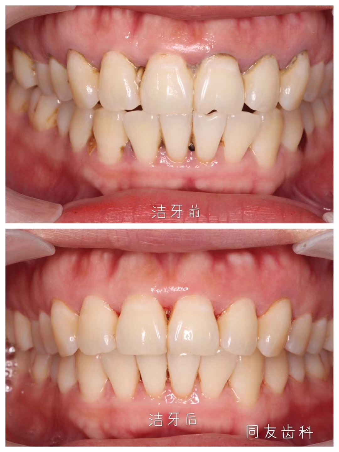 洗牙前后高清图图片