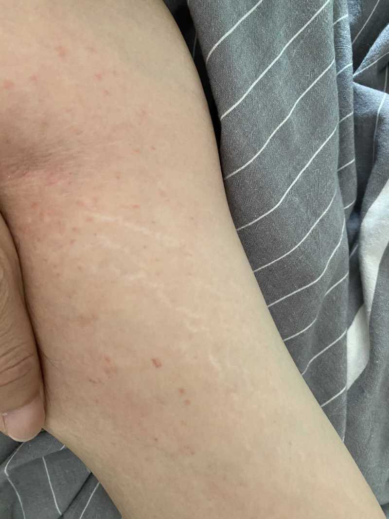 膀子内侧长了一些红点点,挠上去有些刺挠痒,请教下各位坛友这是啥